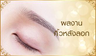 สักคิ้วหลังลอก