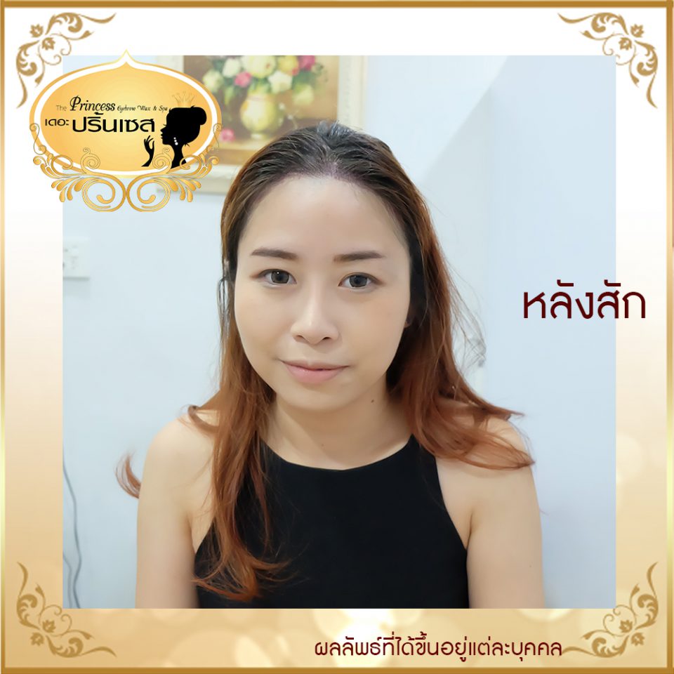 สอนสักไรผม แก้หัวล้าน หาดใหญ่ กรุงเทพ