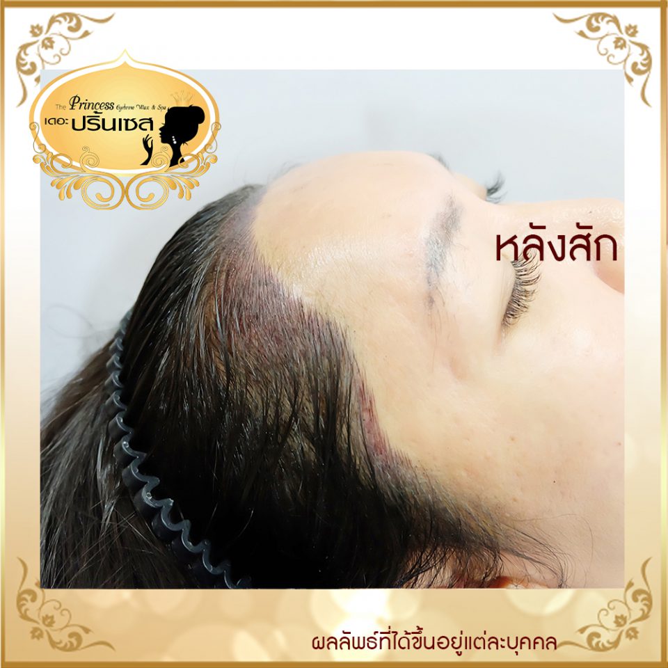 สอนสักไรผม แก้หัวล้าน หาดใหญ่ กรุงเทพ