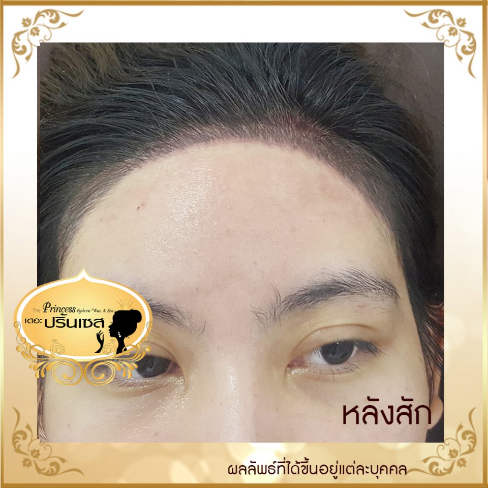 สอนสักไรผม แก้หัวล้าน หาดใหญ่ กรุงเทพ